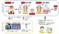 次世代バイオインプラント、都内でも臨床研究開始