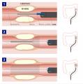 オリンパス、悪性腫瘍による消化管閉塞の治療に用いる