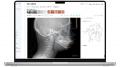 AIが矯正歯科の「重ね合わせ」解析を完全自動化　クラ