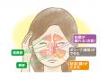 副鼻腔炎をテーマとした健康ぷらざ（日本医師会制作）