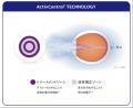 【日本初】近視進行抑制治療を目的としたソフトコンタ 【日本初】近視進行抑制治療を目的としたソフトコンタ