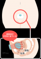 排泄予測デバイス「DFree」、BabyTech(R) Awards 2025