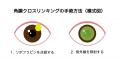未成年の円錐角膜患者に、治療の機会を届けたいutf-8 未成年の円錐角膜患者に、治療の機会を届けたいutf-8