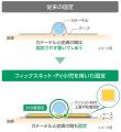 「確保した1本の点滴ルートを守りたい」意図しない針