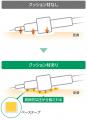 「確保した1本の点滴ルートを守りたい」意図しない針