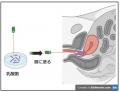 【岡山大学】くり返す膀胱炎に、塗る乳酸菌治療~抗菌 【岡山大学】くり返す膀胱炎に、塗る乳酸菌治療~抗菌