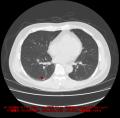 胸部CT画像診断支援AI「EIRL Chest CT」、計測機能の