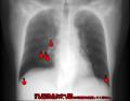 胸部CT画像診断支援AI「EIRL Chest CT」、計測機能の