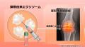 【再生医療の新たなエビデンス】変形性膝関節症に対す