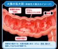 玄米・米糠発酵食品（FBRA）、潰瘍性大腸炎患者を対象
