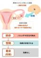 緊急避妊薬（アフターピル）「ノルレボ(R)」をもっと