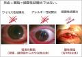 キノロン系抗菌薬点眼の使いすぎが問題に！正しい診察