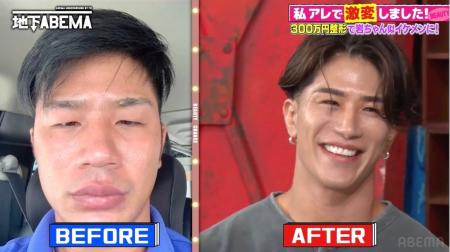 ビフォーアフター動画が1000万再生超え！整形費用300
