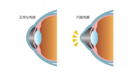 未成年の円錐角膜への角膜クロスリンキングの費utf-8