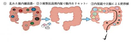 寛解導入率45.9％を達成 ―潰瘍性大腸炎に対する腸内細