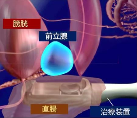 西日本初!先進医療 HIFU(ハイフ)を用いた前立utf-8 西日本初!先進医療 HIFU(ハイフ)を用いた前立utf-8