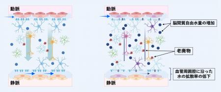 対側脳領域の脳間質液動態が膠芽腫患者の生存期間を予 対側脳領域の脳間質液動態が膠芽腫患者の生存期間を予