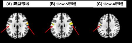 社交不安症患者の脳活動に新発見～感覚処理領域の活動