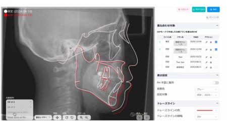 AIが矯正歯科の「重ね合わせ」解析を完全自動化　クラ