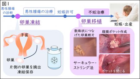【日本初】移植卵巣から得た卵子による妊娠・出産に成