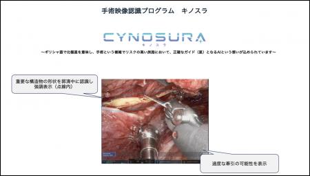 Direava株式会社、AI搭載 「手術映像認識プログラム 