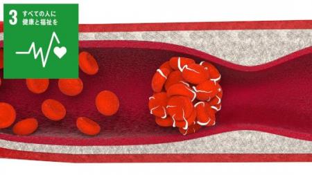 世界初!血液の“固まりやすさ”を検出する血液検査SMAT 