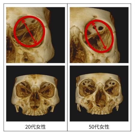 顔のたるみは「肌」ではなく「骨」が原因！？