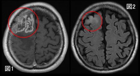 膠芽腫の画像起源の解明～いつから腫瘍は存在しutf-8