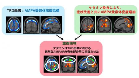 【横浜市立大学】ケタミンがうつ症状を改善するutf-8