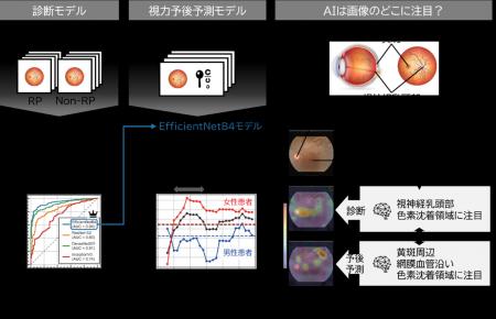AIで網膜色素変性症患者の数年後の視力を予測ー眼底写