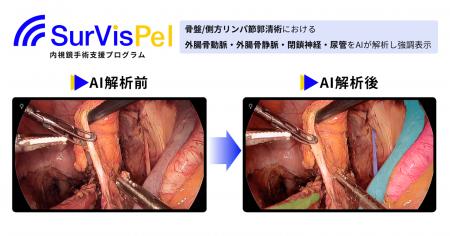 Jmeesと国立がん研究センター東病院が共同開発した「