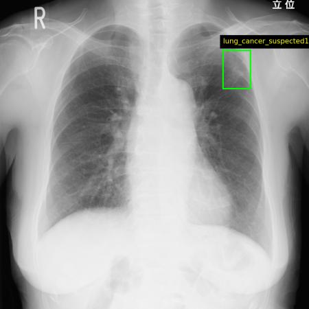 Callisto、AI・臨床研究用の肺がん疑いX線と前立腺が