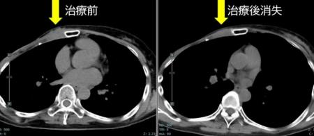 BNCT（ホウ素中性子捕捉療法）を自費診療で導入・提供