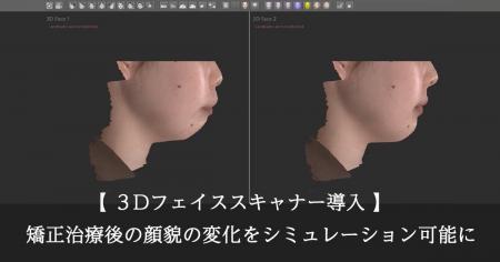 松山市の大谷歯科矯正歯科、3Dフェイススキャナー「MO