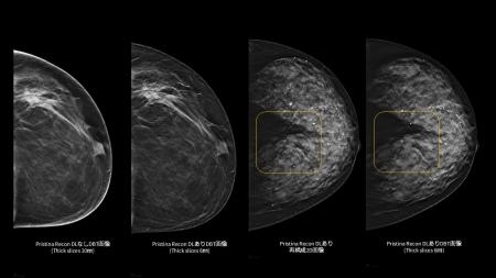 GEヘルスケア・ジャパン、乳房用X線診断装置 「Pristi