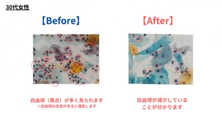 デリケートゾーンソープ、およびオイル使用による膣内