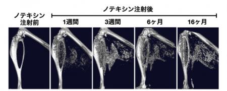 石灰化筋壊死症を再現する新規マウスモデルを確立