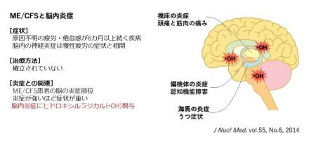 低濃度水素吸入による筋痛性脳脊髄炎／慢性疲労症候群