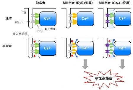 手術時に発症する難治性疾患の新たな原因を解明