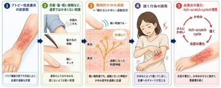 アトピー性皮膚炎患者の「触れるとかゆい」症状と相関 アトピー性皮膚炎患者の「触れるとかゆい」症状と相関