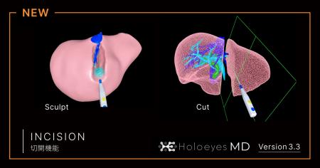 Holoeyes、医療用画像処理ソフトウェア「Holoeyes MD