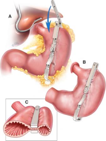 胃を切らずに肥満症を治療するB-Clamp®手術をアutf-8 胃を切らずに肥満症を治療するB-Clamp®手術をアutf-8