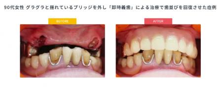 年金生活で「噛むこと」を諦める高齢者が増加「utf-8 年金生活で「噛むこと」を諦める高齢者が増加「utf-8
