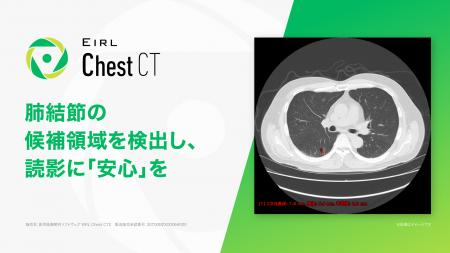 胸部CT画像診断支援AI「EIRL Chest CT」、計測機能の