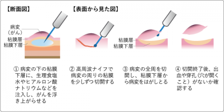 未分化型早期胃がんに対する内視鏡治療（ESD）の有効