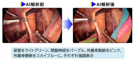 骨盤リンパ節郭清を支援する手術AIの有用性を外科医36
