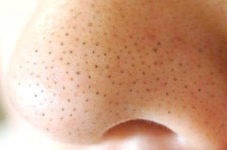 ■【秋の毛穴トラブル急増に注意】夏のダメージが押し ■【秋の毛穴トラブル急増に注意】夏のダメージが押し