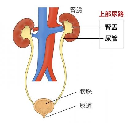 上部尿路（腎盂・尿管）がん術後の膀胱内再発予防にピ