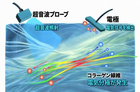 超音波で骨粗鬆症による骨の質的変化を検出 超音波で骨粗鬆症による骨の質的変化を検出