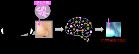 画像認識AI（※1）でニキビの原因菌（※2）を可視化する